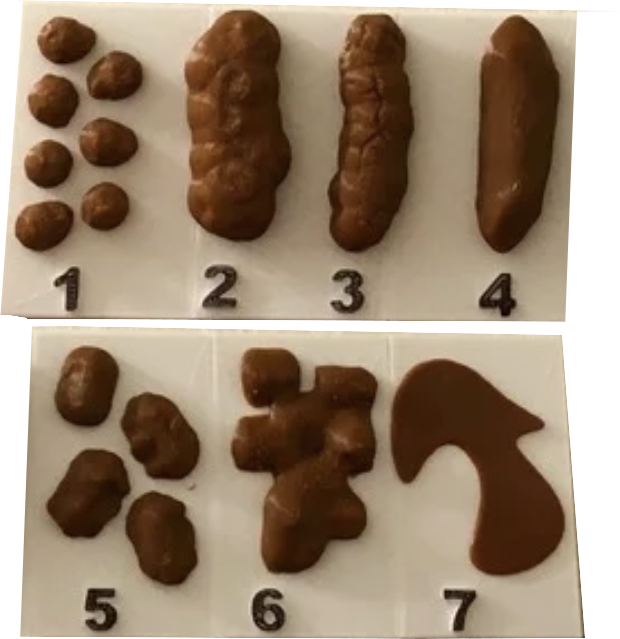 Die Bristol-Stuhlskala-Tabelle mit allen sieben Stuhltypen und Beschreibungen von Konsistenz und zugehöriger Transitzeit