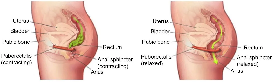 Diagramma di un pavimento pelvico contratto che blocca l'uscita delle feci rispetto a un pavimento pelvico rilassato che permette il passaggio delle feci